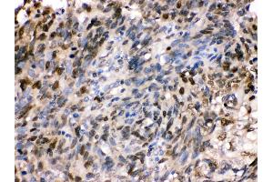 Anti- HSPA2 Picoband antibody,IHC(P) IHC(P): Human Lung Cancer Tissue