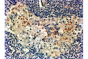 ABIN185029 (2µg/ml) staining of paraffin embedded Human Breast Cancer.