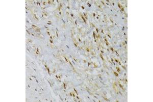 Immunohistochemistry of paraffin-embedded human adenomyosis using HNRNPA1 Antibody (ABIN5975570) at dilution of 1/100 (40x lens). (HNRNPA1 anticorps)