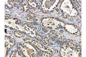 ABIN6258547 and ABIN6275031 at 1/100 staining human ovarian cancer by IHC-P. (C1QL2 anticorps  (C-Term))