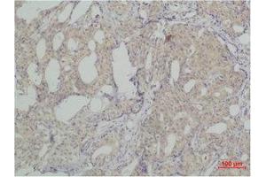 Immunohistochemistry (IHC) analysis of paraffin-embedded Human Breast Carcicnoma using SLUG Polyclonal Antibody. (SLUG anticorps)