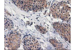 Immunohistochemical staining of paraffin-embedded Adenocarcinoma of Human breast tissue using anti-GBA3 mouse monoclonal antibody. (GBA3 anticorps  (AA 1-150, AA 370-469))