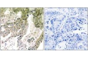 Immunohistochemistry analysis of paraffin-embedded human lung carcinoma tissue, using LAMA5 Antibody. (Laminin alpha 5 anticorps  (AA 2381-2430))