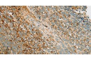 Immunohistochemistry of paraffin-embedded Human ovarian cancer tissue using AMPK alpha1 Polyclonal Antibody at dilution 1:70 (PRKAA1 anticorps)