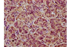 IHC image of ABIN7161019 diluted at 1:200 and staining in paraffin-embedded human liver cancer performed on a Leica BondTM system.