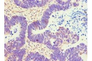 Immunohistochemistry of paraffin-embedded human ovarian cancer using ABIN7144840 at dilution of 1:100 (ATP5B anticorps  (AA 230-529))