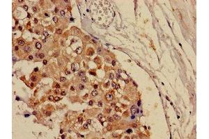 Immunohistochemistry of paraffin-embedded human breast cancer using ABIN7146825 at dilution of 1:100