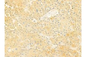 ABIN6261135 and ABIN6278939 at 1/100 staining human hepatocellular carcinoma by IHC-P. (CYB5R4 anticorps  (N-Term))