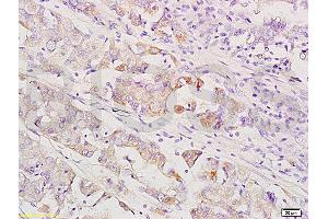 Formalin-fixed and paraffin embedded human gastric carcinoma labeled with Anti-MEK1/2(MAPKK1) Polyclonal Antibody, Unconjugated (ABIN736791) at 1:200 followed by conjugation to the secondary antibody and DAB staining.