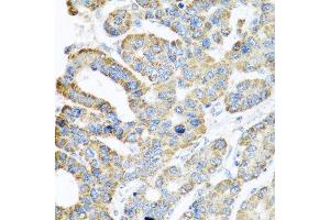 Immunohistochemistry of paraffin-embedded human liver cancer using ATPIF1 antibody at dilution of 1:100 (x40 lens). (ATPase Inhibitory Factor 1 anticorps)