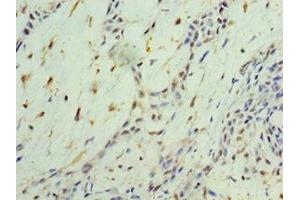 Immunohistochemistry of paraffin-embedded human breast cancer using ABIN7161910 at dilution of 1:100 (NR4A1 anticorps  (AA 1-170))