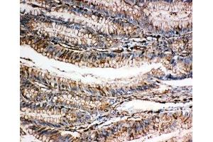 IHC-P: Gelsolin antibody testing of human intestine cancer tissue