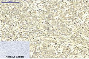 Immunohistochemical analysis of paraffin-embedded human breast cancer tissue. (ABCB5 anticorps)