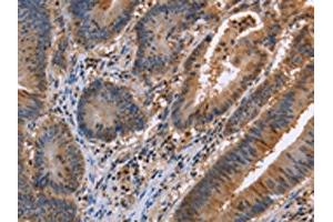 The image on the left is immunohistochemistry of paraffin-embedded Human colon cancer tissue using ABIN7129424(FAAH2 Antibody) at dilution 1/30, on the right is treated with fusion protein. (FAAH2 anticorps)