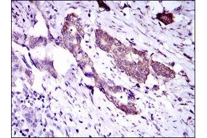 Immunohistochemical analysis of paraffin-embedded esophageal cancer tissues using DNAL4 mouse mAb with DAB staining. (DNAL4 anticorps  (AA 1-105))