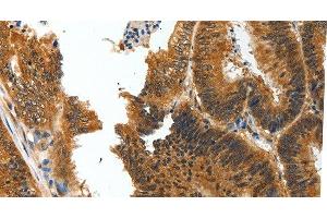 Immunohistochemistry of paraffin-embedded Human colon cancer tissue using BIRC6 Polyclonal Antibody at dilution 1:30 (BIRC6 anticorps)