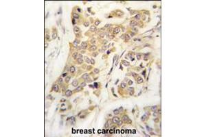Formalin-fixed and paraffin-embedded human breast carcinoma tissue reacted with CDH8 antibody , which was peroxidase-conjugated to the secondary antibody, followed by DAB staining. (Cadherin 8 anticorps  (N-Term))