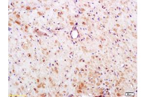 Formalin-fixed and paraffin embedded human gastric carcinoma labeled with Anti-S100A13 Polyclonal Antibody, Unconjugated (ABIN748073) at 1:200 followed by conjugation to the secondary antibody and DAB staining. (S100A13 anticorps  (AA 51-98))