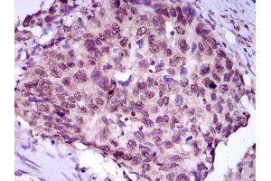 Immunohistochemical analysis of paraffin-embedded esophageal cancer tissues using MEF2C mouse mAb with DAB staining.