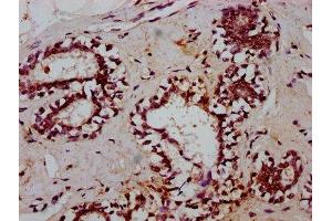 IHC image of ABIN7172427 diluted at 1:600 and staining in paraffin-embedded human breast cancer performed on a Leica BondTM system.