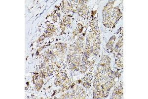 Immunohistochemistry of paraffin-embedded human breast cancer using PSAP Rabbit pAb (ABIN3022605, ABIN3022606, ABIN3022607, ABIN1513432 and ABIN6218938) at dilution of 1:50 (40x lens). (Prosaposin anticorps  (AA 60-310))