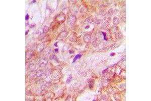 Immunohistochemical analysis of UBE3B staining in human breast cancer formalin fixed paraffin embedded tissue section. (UBE3B anticorps)