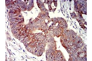 Immunohistochemical analysis of paraffin-embedded rectum cancer tissues using P2RY4 mouse mAb with DAB staining.