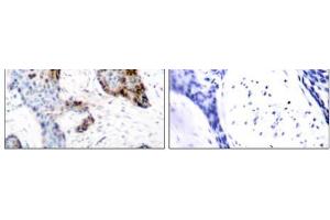 Immunohistochemical analysis of paraffin-embedded human breast carcinoma tissue using Estrogen Receptor-α (Ab-118) antibody (E021067). (Estrogen Receptor alpha anticorps)