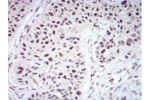Immunohistochemical analysis of paraffin-embedded esophageal cancer tissues using WTAP mouse mAb with DAB staining.