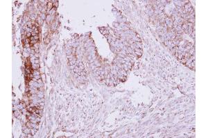IHC-P Image Immunohistochemical analysis of paraffin-embedded human colon carcinoma, using MCC, antibody at 1:250 dilution. (MCC anticorps  (Center))
