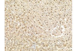 eIF4ENIF1 Antibody at 1/100 staining Human breast cancer by IHC-P.