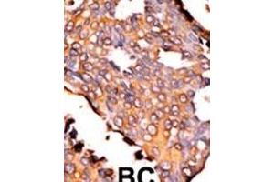 Formalin-fixed and paraffin-embedded human cancer tissue reacted with the primary antibody, which was peroxidase-conjugated to the secondary antibody, followed by AEC staining.