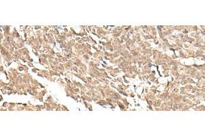 Immunohistochemistry of paraffin-embedded Human lung cancer tissue using KDM2A Polyclonal Antibody at dilution of 1:55(x200)