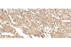 Immunohistochemistry of paraffin-embedded Human lung cancer tissue using KDM2A Polyclonal Antibody at dilution of 1:55(x200) (KDM2A anticorps)