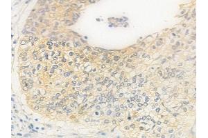 ABIN6262683 and ABIN6278907 at 1/100 staining human cervical carcinoma by IHC-P. (ITGA8 anticorps  (C-Term))
