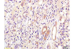 Formalin-fixed and paraffin embedded human kidney carcinoma labeled with Anti CD75 Polyclonal Antibody, Unconjugated (ABIN704201) at 1:200 followed by conjugation to the secondary antibody and DAB staining. (ST6GAL1 anticorps  (AA 301-406))