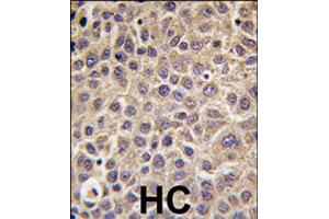 Immunohistochemistry (Formalin/PFA-fixed paraffin-embedded sections) of human hepatocellular carcinoma with MTMR9 polyclonal antibody , followed by peroxidase-conjugated secondary antibody and DAB staining. (MTMR9 anticorps  (C-Term))