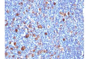 Formalin-fixed, paraffin-embedded human Hodgkin's Lymph stained with Fascin-1 Mouse Monoclonal Antibody (SPM133) (Fascin anticorps)