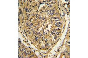 Formalin-fixed and paraffin-embedded human lung carcinoma with FGFR2 Antibody, which was peroxidase-conjugated to the secondary antibody, followed by DAB staining.
