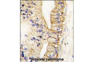 Formalin-fixed and paraffin-embedded human prostata carcinoma tissue reacted with CDH7 antibody , which was peroxidase-conjugated to the secondary antibody, followed by DAB staining.