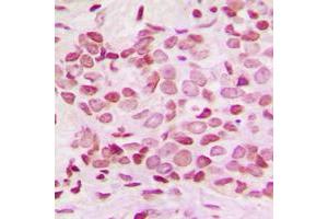 Immunohistochemical analysis of NF-kappaB p100 (pS865) staining in human breast cancer formalin fixed paraffin embedded tissue section.