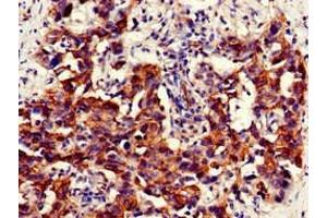 Immunohistochemistry of paraffin-embedded human bladder cancer using ABIN7161574 at dilution of 1:100 (NAMPT anticorps  (AA 1-280))