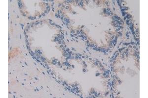 Detection of Hepc in Human Prostate Tissue using Monoclonal Antibody to Hepcidin (Hepc)