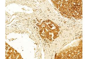 ABIN6262072 and ABIN6266555 at 1/100 staining Human normal tissues adjacent to liver cancer by IHC-P. (Granzyme B/H (N-Term) anticorps)