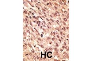 Formalin-fixed and paraffin-embedded human cancer tissue reacted with the primary antibody, which was peroxidase-conjugated to the secondary antibody, followed by AEC staining.