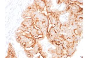 Formalin-fixed, paraffin-embedded human Ovarian Carcinoma stained with MUC16 Mouse Monoclonal Antibody (MUC16/1860). (MUC16 anticorps)