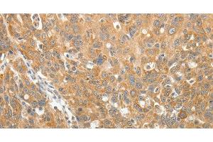 Immunohistochemistry of paraffin-embedded Human ovarian cancer using AKR1B1 Polyclonal Antibody at dilution of 1:30 (AKR1B1 anticorps)