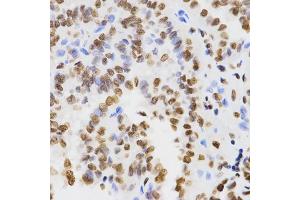 Immunohistochemistry of paraffin-embedded human thyroid cancer using DiMethyl-Histone H3-K9 antibody (ABIN1872998) at dilution of 1:200 (40x lens).