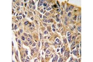 IHC analysis of FFPE human lung carcinoma tissue stained with RIPK3 antibody