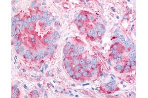 Anti-KDR / VEGFR2 antibody IHC of human Breast, Carcinoma.